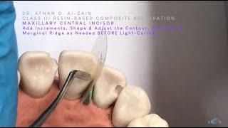 Class III composite restoration (2)–Maxillary incisor–Strip over restoration technique - Arabic عربي