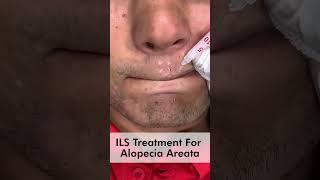 ILS treatment for alopecia areata | Alopecia Areata Beard Treatment | Skinaa Clinic #shorts #viral