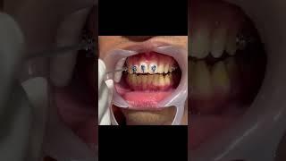 Damon Braces: Advanced Self ligating braces #braces #dentist #mydentistchandigarh #smile