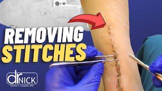 Does Getting Stitches Out Hurt?