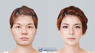 let me in korean show (jawline, rhinoplasty, cheekbone reduction) plastic surgery before and after