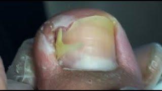 Incredible sharp nail under toe -Nail Tutorials