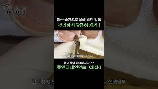 뜯는 습관으로 살에 박힌 발톱!? 뿌리까지 깔끔히~~ 제거!^^ #레푸스 #일산레푸스 #내성발톱 #무좀발톱 #ingrown_toenail #일산내성발톱 #일산무좀발톱 #발톱