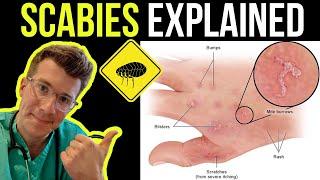 Doctor explains SCABIES skin rash, including SYMPTOMS, PHOTOS OF SKIN, TREATMENT & more