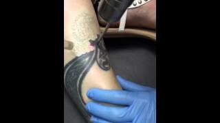 Laser Tattoo Removal Leg Seriously Skin Chagrin Falls, Ohio Dr. Jennifer Kish