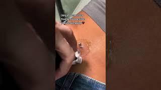 Piercing Migration Treatment + Piercing Bump Removal ft Base Laboratories Piercing Bump Treatment