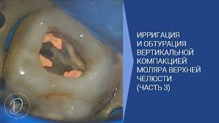 Ирригация и обтурация моляра верхней челюсти (часть 3)