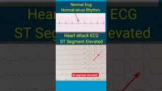 Normal v/s Heart attack Ecg l #ecg #heartattack #angiography #shorts