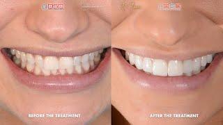 Cosmetic Dentist Toronto  - How many appointments do you need for veneers? - Porcelain Veneer Case