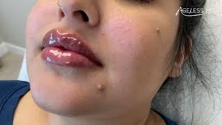 Other Amazing Lip filler treatment - Ageless MD