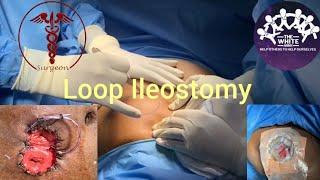 ILEOSTOMY- Stepwise Demonstration