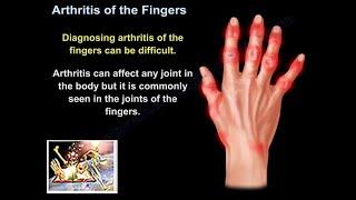 Arthritis Of The Fingers - Everything You Need To Know - Dr. Nabil Ebraheim