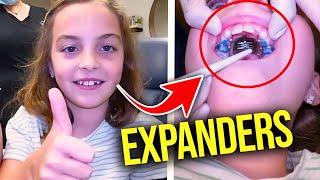 Getting a Palatal Expander....How expanders work | McKinney Orthodontist