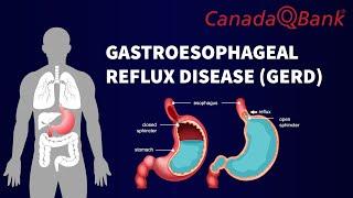 Gastroesophageal Reflux Disease (GERD)