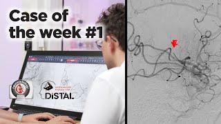 Case of the week #1 Adapting to the anatomy in an interesting secondary MeVO case!!!