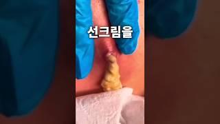 여드름 났을때 이렇게 선크림바르세요(이거 모르면 피부 망가집니다)