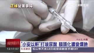 「小安以軒」打玻尿酸　額頭化膿變爛臉｜三立新聞台