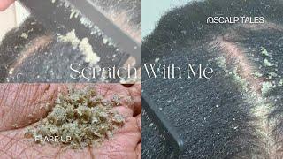 Dandruff Scratching | Part 2