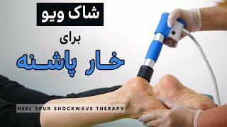 درمان فیزیوتراپی خار پاشنه با دستگاه پرطرفدار شاک ویو-Heel spur extracorporeal shockwave therapy