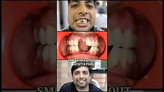 SMILE MAKEOVER FOR ANTERIOR TEETH..#smile #dental #teeth #trending #youtube #shorts