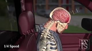 Rear End Collision - Brain Injury