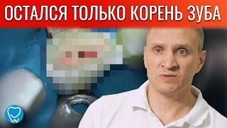 Остался только корень зуба. Что делать? Как восстановить? - Стоматология Доктора Коннова.