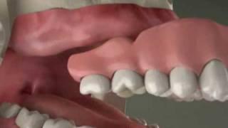 Dental Implants - Implant Overdenture in Denville, NJ