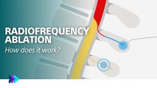 How Radiofrequency Ablation (RFA) procedure works