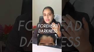 forehead darkness #skincare #shorts