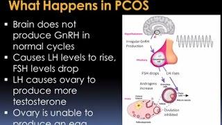 Understanding Polycystic Ovary Syndrome Video – Brigham and Women’s Hospital