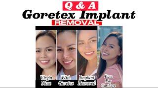 REMOVAL OF GORETEX IMPLANT UPDATE | Q & A | RHINOPLASTY