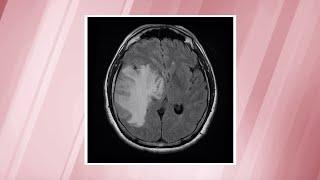 Glioblastoma—the most commonly-diagnosed brain cancer | OSUCCC – James