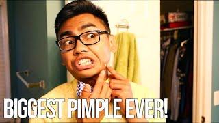 THE BIGGEST PIMPLE EVER - #UpYourGame