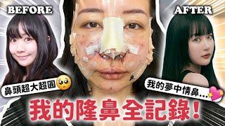 最真實的整形紀錄：隆鼻痛嗎？花多少錢？恢復期多久？｜蘿倫 Lauren ft.依心唯美整型外科 謝東穎醫師 @followheart