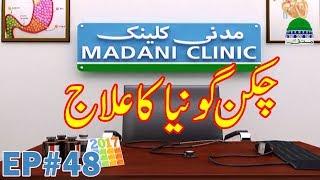 Fever Disease | Chikungunya Treatment | چکن گونیا کا علاج | Madani Clinic Ep 48 | Symptoms | Cure