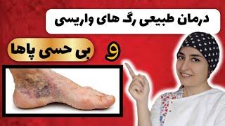 خطرات واریس رو نمیدونی؟درمان سردی و بی حسی پاها