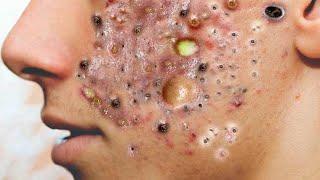 Big Cystic Acne Blackheads Extraction Blackheads & Milia, Whiteheads Removal Pimple Popping # 1065