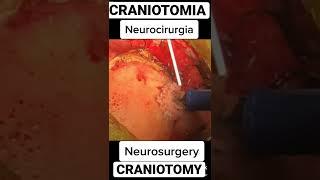 Craniotomia - Neurocirurgia #shorts #saude