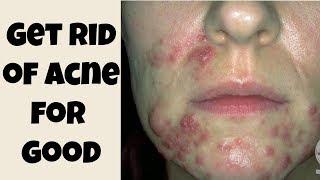 How To Get Rid of Acne (& Scars) For Good & Keep It Away  Step By Step Guide