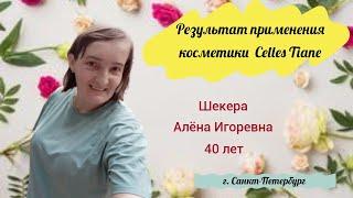 Результат применения косметики Celles Tiane. Шекера Алена Игоревна, 40 лет, г. Санкт-Петербург.