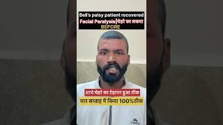 चार सप्ताह में किया 100% ठीक चेहरे का लकवा ||  #bellspalsy #paralysis !