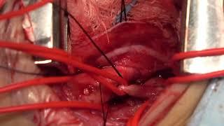 [Full HD] Coarctation of The Aorta Repair (extended end to end anastomosis)