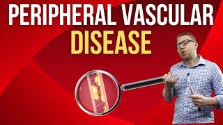 Peripheral Vascular Disease