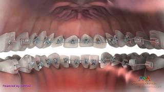 Hidden or Lingual Braces