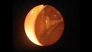 Colonoscopy - caecum adhesion to abdomen wall part 1.