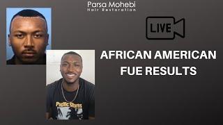 African American FUE Hair Restoration Results