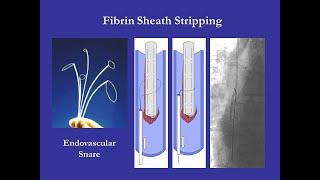 Fibrin Sheath Stripping | stripping of fibrin sheath from perm cath tip in hyderabad by Dr Shailesh