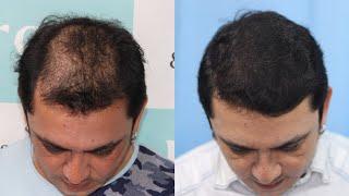 Best Hair Transplant Result 2021 || Diffuse Pattern || 3,512 Grafts || Regrow Clinic Haridwar