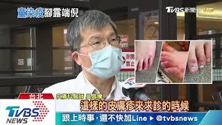 腳趾凍瘡、皰疹！美研究「無症狀者」確診徵兆