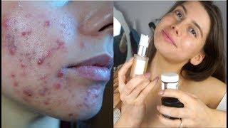 MY SIMPLE MORNING SKINCARE ROUTINE FOR ACNE FREE SKIN!! || pt. 2 , how to get rid of acne!